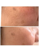 サロン エム(Salon M)/肌改善プラズマエクソソーム導入