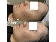 ハウピア 烏丸(Haupia)/【何をしても変わらない肌改善】