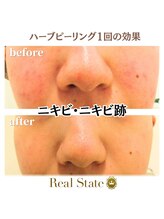 レアルステイト 御経塚店/ハーブピーリング/毛穴/ニキビ