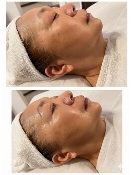 セルラム(cellulam)/【before→ after】