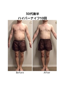 ビハダエステ 町田店(BIHADAエステ)/【B/A】30代後半ハイパーナイフ