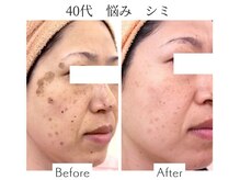 ファニービー 吹田店/40代 シミ 10ヶ月で改善