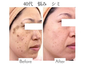 ファニービー 吹田店/40代 シミ 10ヶ月で改善