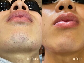 ミホノ 和泉中央店(mihono)/学生顔脱毛