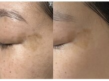 モガナ(mogana)/40代・肌育シミケア