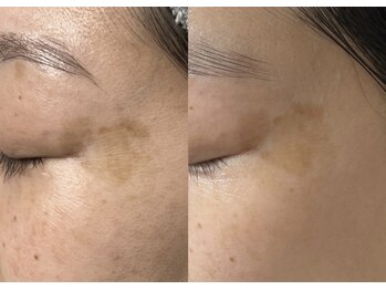 モガナ(mogana)/40代・肌育シミケア