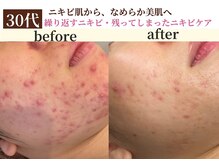 パールホワイトニング/30代 ニキビ改善