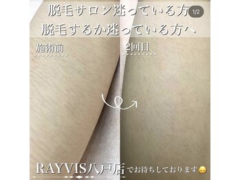 エステティック レイビス 八戸店(RAYVIS)/光脱毛日本で1番最初がレイビス