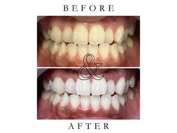 ジュエルホワイトニング/ホワイトニングビフォーアフター