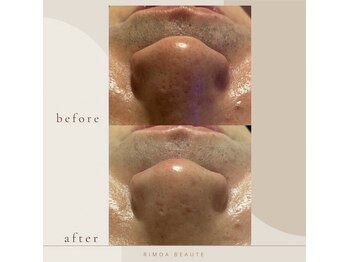リモアボーテ(RIMOA beaute)/施術メニュー　ヒゲ脱毛