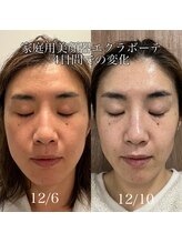 リュウ(le.lieu)/美顔器4日間でこの変化