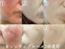 クレアナ ザ ビューティー(KULEANA the beauty)/ハーブピーリング