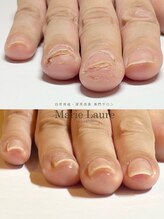 マリーロール 梅田店(Marie Laure)/自爪育成/深爪矯正/ネイルケア