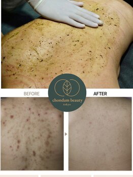チョンダムビューティー(chondam beauty)/ボディにもハーブピーリング