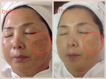 サロン ド ラポール/シミケア6回　before→after