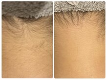 クラン シュプール 表参道店/【脱毛】