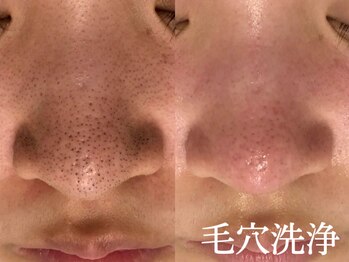 サロン ラズリ(SALON Lazuli)/【毛穴洗浄】角質・角栓を改善