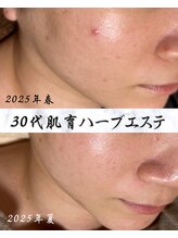 サロン ド エン(Salon de. en)/毛穴ニキビ◇ハーブピーリング