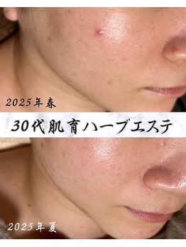 サロン ド エン(Salon de. en)/毛穴ニキビ◇ハーブピーリング