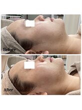 ルピア(L'pur)/リフトアップ