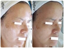 チューズコレクション(choose collection)/ハーバルピーリング