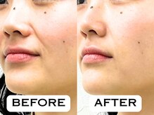 ビハリスト 恵比寿/ほうれい線とフェイスライン