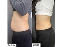 アエ メゾン(ae maison)/【施術1回】ウエスト