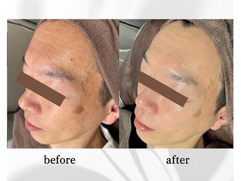 アン ビューティー(ann beauty)/リピーター様 40代後半