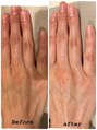 はだなの&nbsp;【ビフォー/アフター】ハンドマッサージ/美白パック/しわ/くすみ