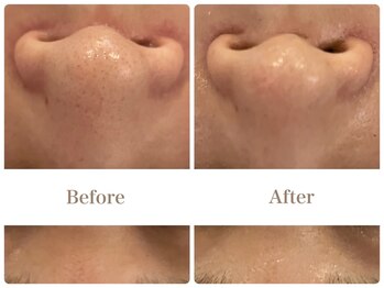 スキンセラピーサロン ル クレール(Le Clair)/Before→After