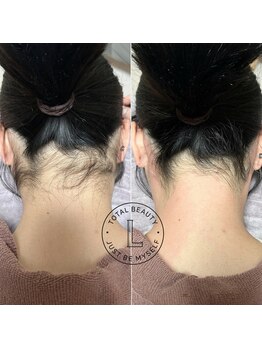 ブラジリアンワックス脱毛サロン ルラ 恵比寿(Lula)/うなじワックス/Before &after