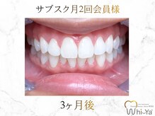 ホワイヤ セルフホワイトニング DBS神楽坂(Whi-Ya)/☆サブスク会員様☆納得の白さ☆