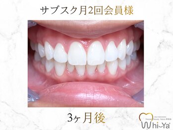 ホワイヤ セルフホワイトニング DBS神楽坂(Whi-Ya)/☆サブスク会員様☆納得の白さ☆