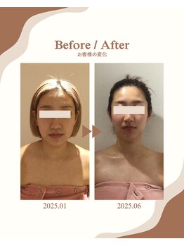 ビーキュート 学芸大学店(BE-CUTE)/Before/After 施術