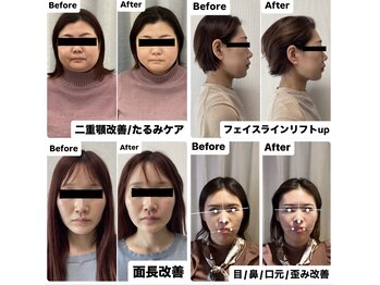 カナエル(CANAEL)の写真/2ヶ月間で自分史上最高の小顔へ★完全オーダーメイドであなた様に特化した施術をご提供