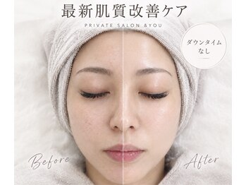 アンドユー(&you)の写真/＼韓国発＊韓国肌管理初代グループ／【吸引しない毛穴洗浄】毛穴の気になる黒ずみ.ざらつきなどに◎