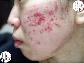 ハーバリー ハーブピーリング 金山店(HERBERRYハーブピーリング)/サロンじゃ無理でしょ?