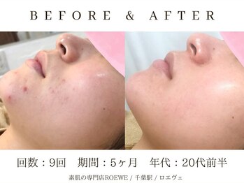 ロエヴェ(ROEWE)/ニキビ改善・毛穴ケア・肌質改善