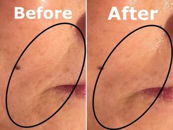 スイ 昭島店(Sui)/超音波＋ハーブピーリング