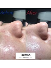 ダーマ(Derma)/メンズ　毛穴洗浄　Before&After