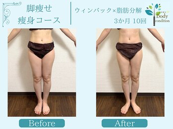 ボディコンディション/ウィンバック/痩身/小顔毛穴洗浄