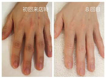 キレイテ 福岡天神店/50代/8回目【天神ハンドケア】