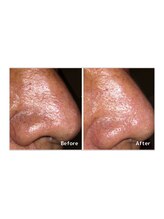 アンドエピ(&epi)/ハイドロヴィーナス症例写真2