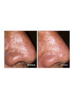 アンドエピ(&epi)/ハイドロヴィーナス症例写真2