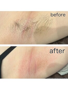 レイモード(Ray mode)/ワックス脱毛&光脱毛