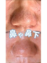 サロン リュンヌ(salon lune)/エクストラクション