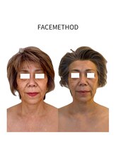 エミナル(EMINALu)/小顔矯正