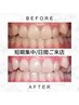 【最短で白い歯に◎】美容ホワイトニング短期集中7日間コース¥35000→