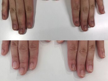 エスネイル(S-nail)/深爪矯正/自爪育成