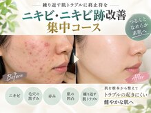ウェルビーイング(well-being)の雰囲気(ニキビ改善集中プログラムで、ニキビ肌にさよなら♪)